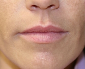 Feel Beautiful - Lip Augmentation with Juvederm, San Diego - Before Photo